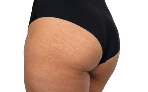 1x striae behandeling
